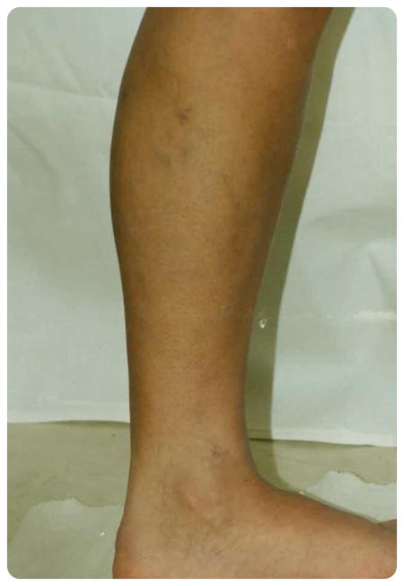 kompressziós lábszárvédők visszerek esetén vásárolni lábműtét visszér következményei