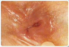 II. fok anlis fissura (krnikus vgblrepeds, vgblgrcs)